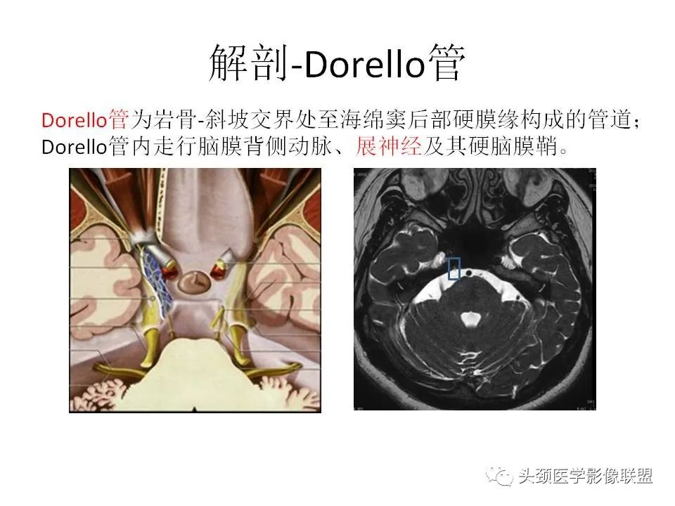 影像PPT - 【PPT】岩尖解剖及常见病变的影像学表现-6