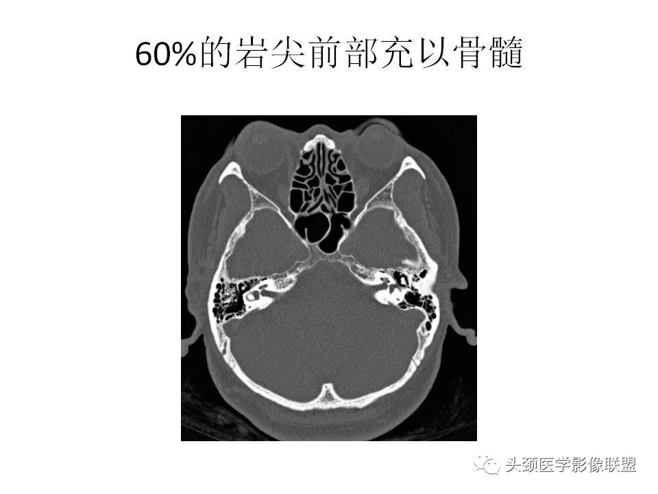 影像PPT - 【PPT】岩尖解剖及常见病变的影像学表现-8