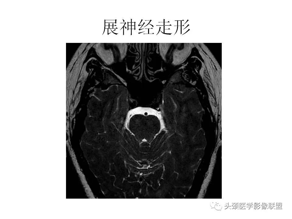 影像PPT - 【PPT】岩尖解剖及常见病变的影像学表现-7