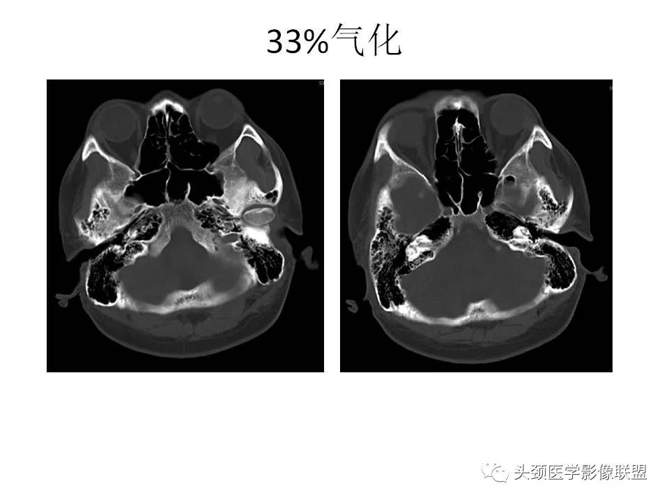 影像PPT - 【PPT】岩尖解剖及常见病变的影像学表现-9