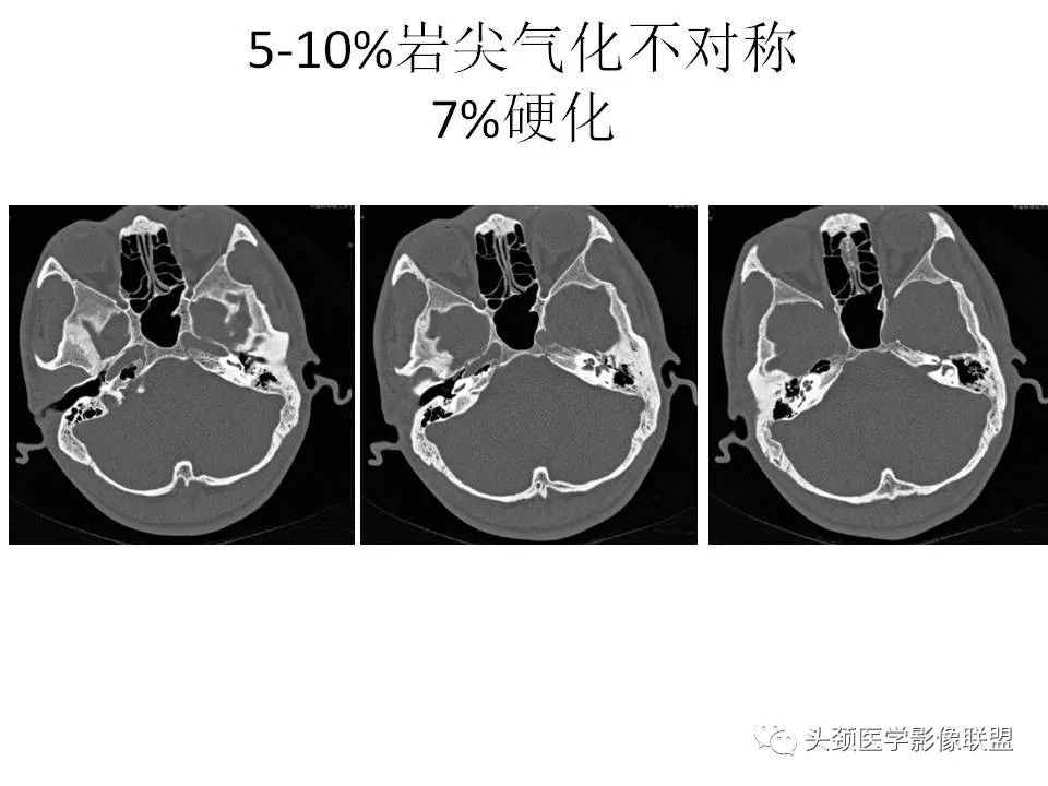 影像PPT - 【PPT】岩尖解剖及常见病变的影像学表现-10