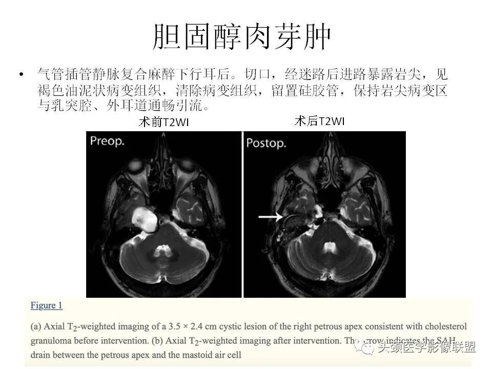 影像PPT - 【PPT】岩尖解剖及常见病变的影像学表现-14