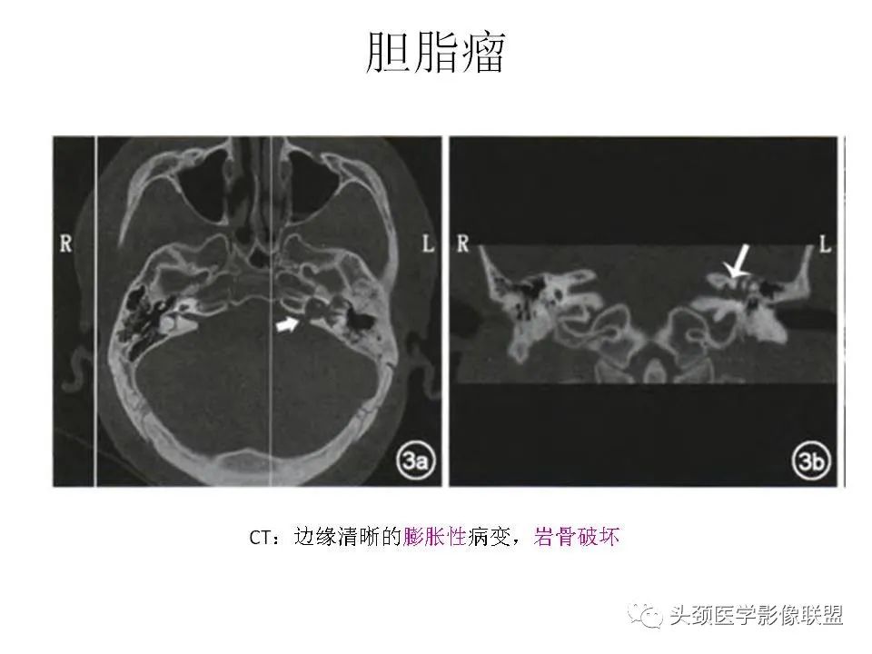 影像PPT - 【PPT】岩尖解剖及常见病变的影像学表现-17