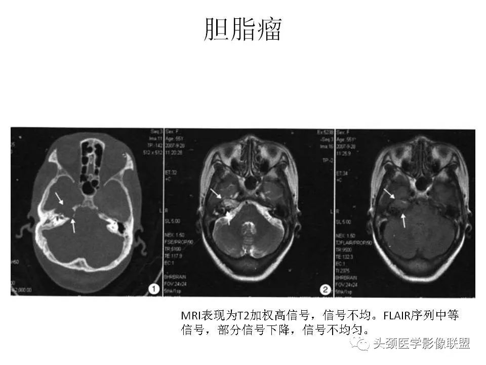 影像PPT - 【PPT】岩尖解剖及常见病变的影像学表现-18