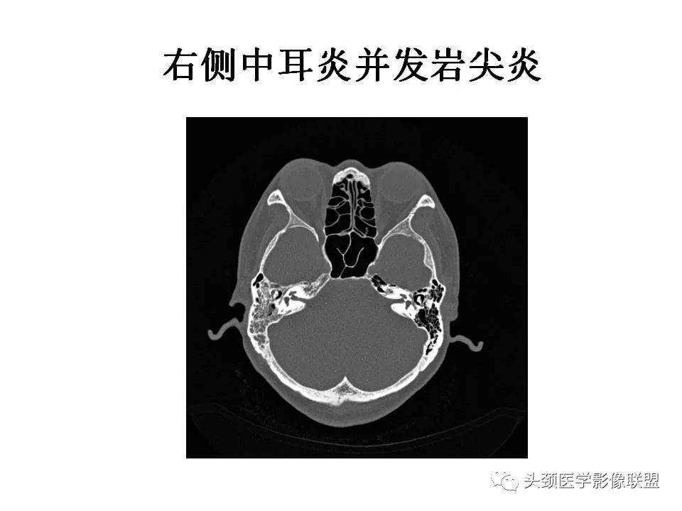 影像PPT - 【PPT】岩尖解剖及常见病变的影像学表现-20