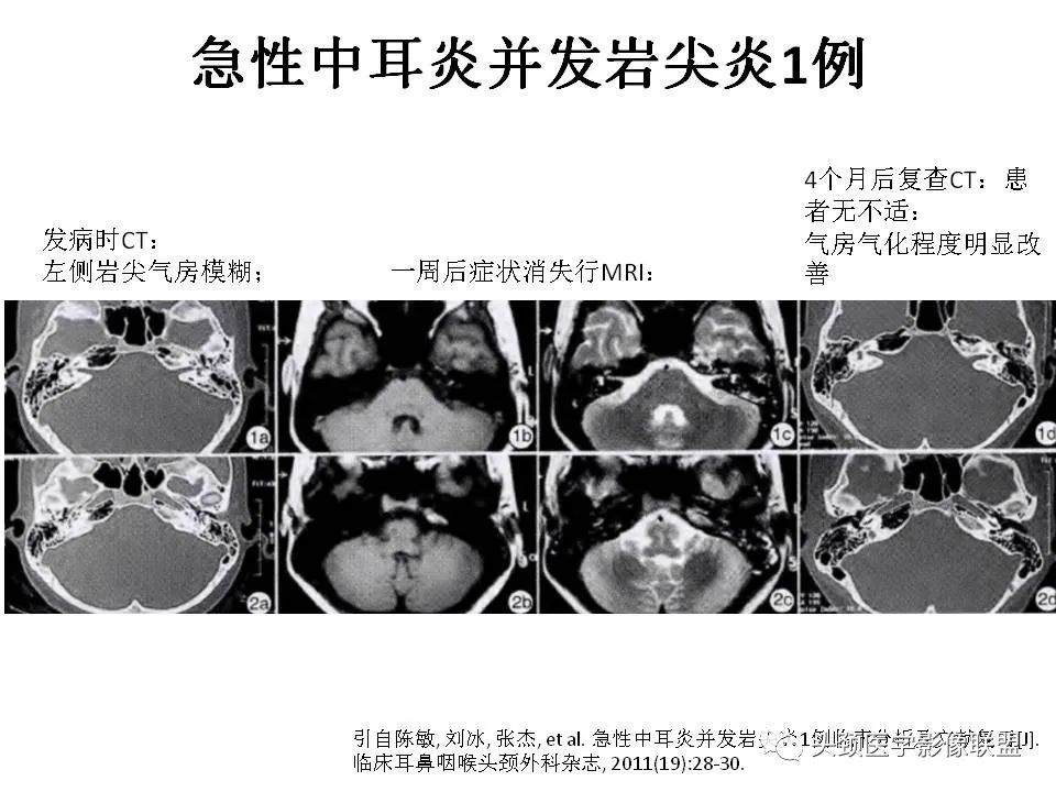 影像PPT - 【PPT】岩尖解剖及常见病变的影像学表现-21