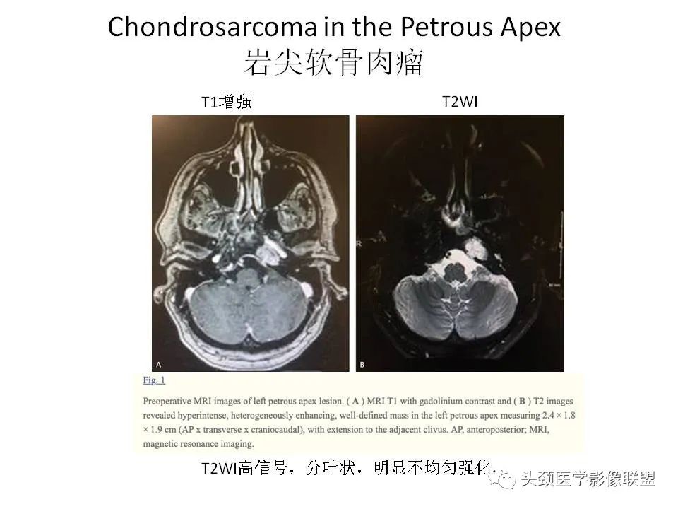 影像PPT - 【PPT】岩尖解剖及常见病变的影像学表现-24