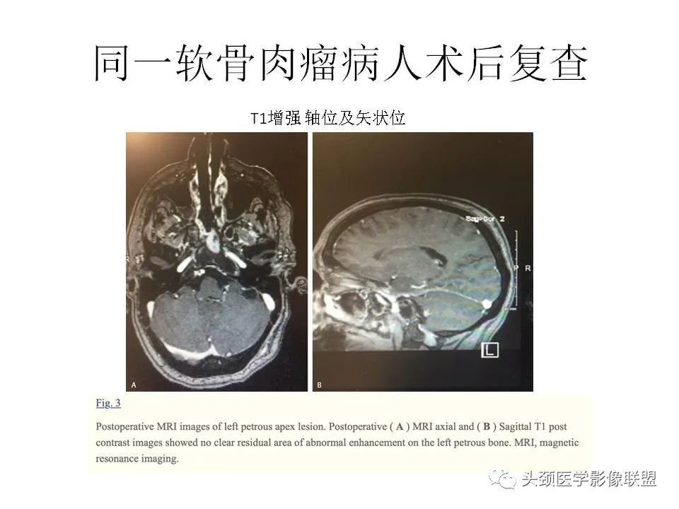 影像PPT - 【PPT】岩尖解剖及常见病变的影像学表现-25