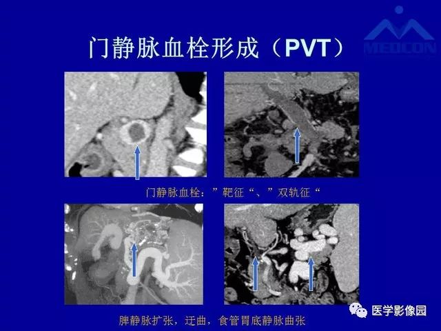 影像PPT - 【PPT】门脉高压分型及影像学特征-9