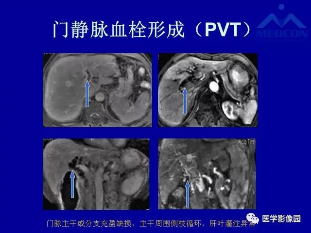 影像PPT - 【PPT】门脉高压分型及影像学特征-10