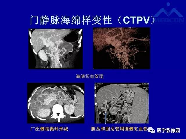 影像PPT - 【PPT】门脉高压分型及影像学特征-12