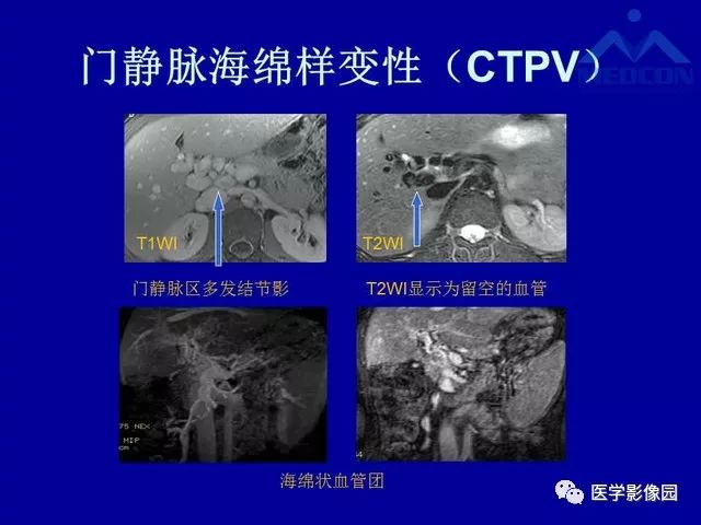 影像PPT - 【PPT】门脉高压分型及影像学特征-13