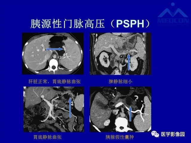 影像PPT - 【PPT】门脉高压分型及影像学特征-15