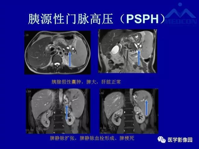 影像PPT - 【PPT】门脉高压分型及影像学特征-16