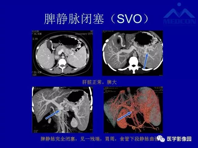 影像PPT - 【PPT】门脉高压分型及影像学特征-18
