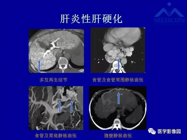 影像PPT - 【PPT】门脉高压分型及影像学特征-21