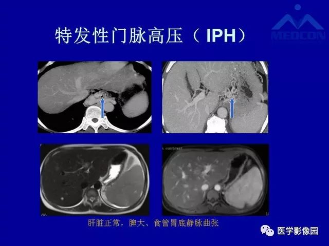影像PPT - 【PPT】门脉高压分型及影像学特征-24