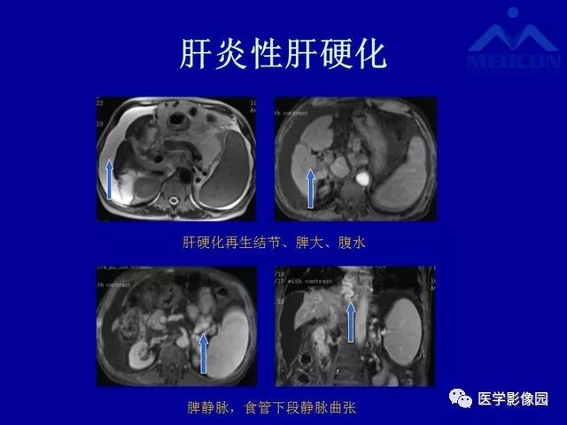 影像PPT - 【PPT】门脉高压分型及影像学特征-22