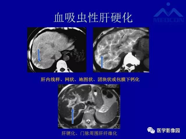 影像PPT - 【PPT】门脉高压分型及影像学特征-26