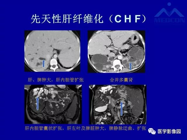 影像PPT - 【PPT】门脉高压分型及影像学特征-28