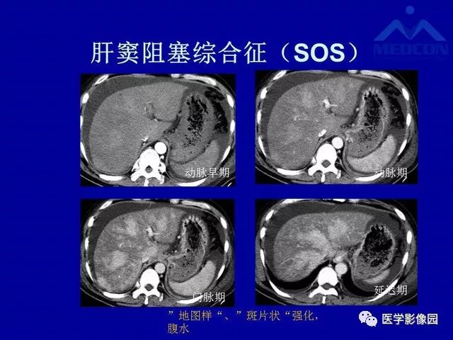 影像PPT - 【PPT】门脉高压分型及影像学特征-30
