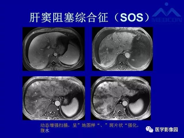 影像PPT - 【PPT】门脉高压分型及影像学特征-31