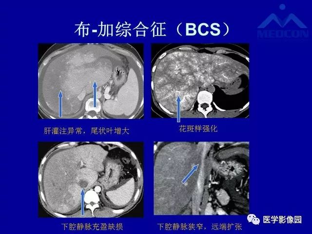 影像PPT - 【PPT】门脉高压分型及影像学特征-34