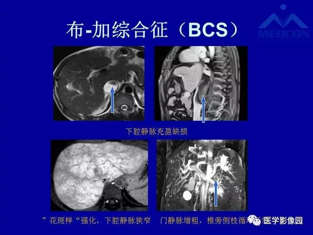 影像PPT - 【PPT】门脉高压分型及影像学特征-35