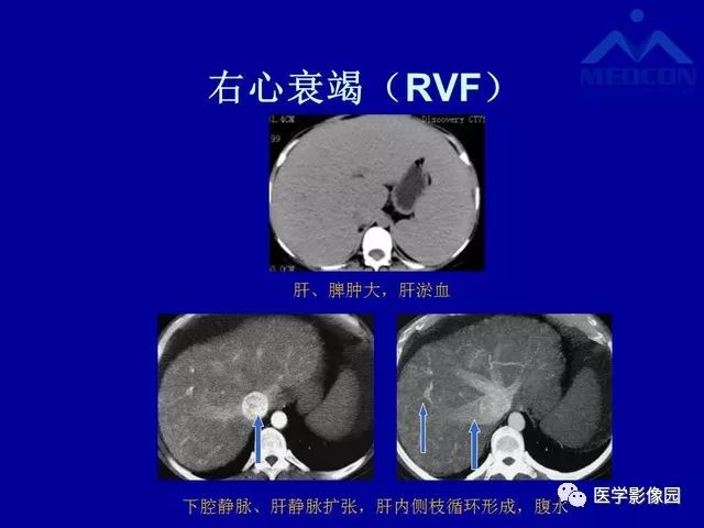 影像PPT - 【PPT】门脉高压分型及影像学特征-37