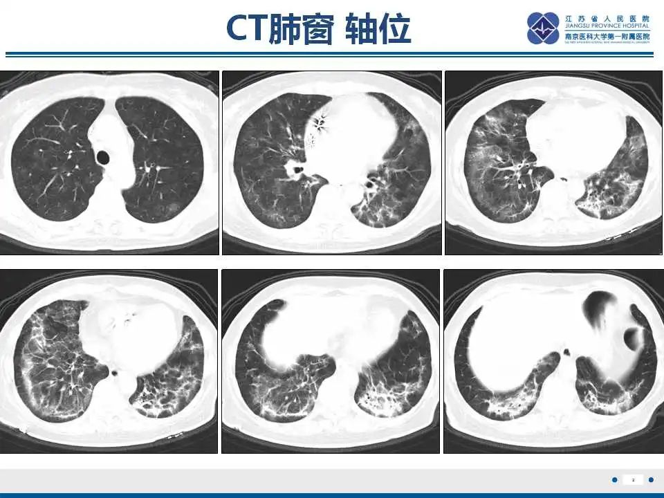 影像PPT - 【PPT】胺碘酮相关性肺损伤-3