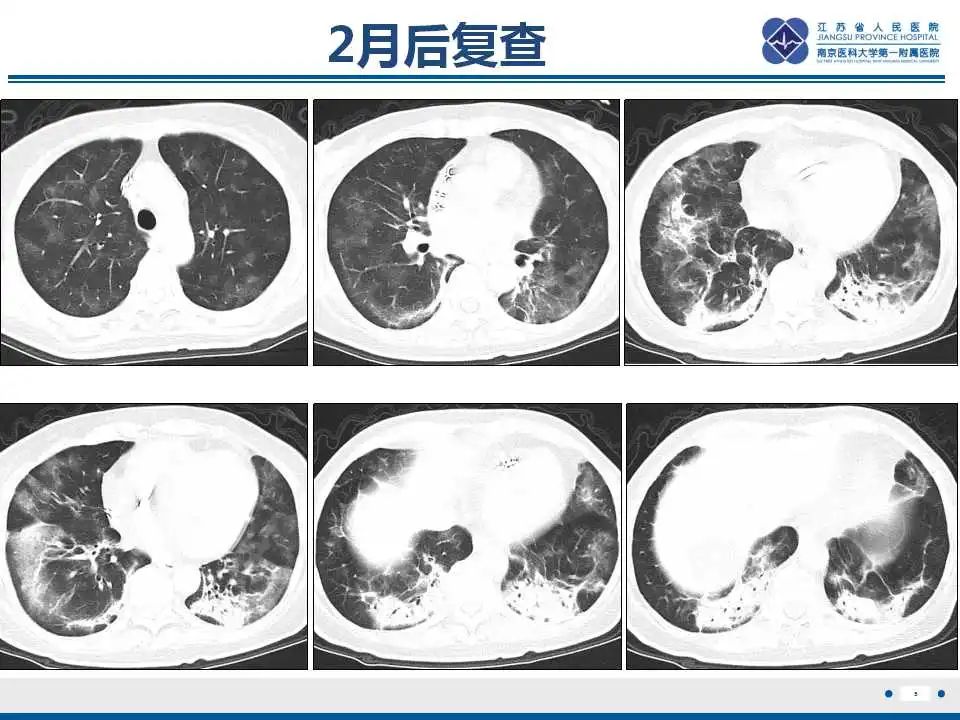 影像PPT - 【PPT】胺碘酮相关性肺损伤-6