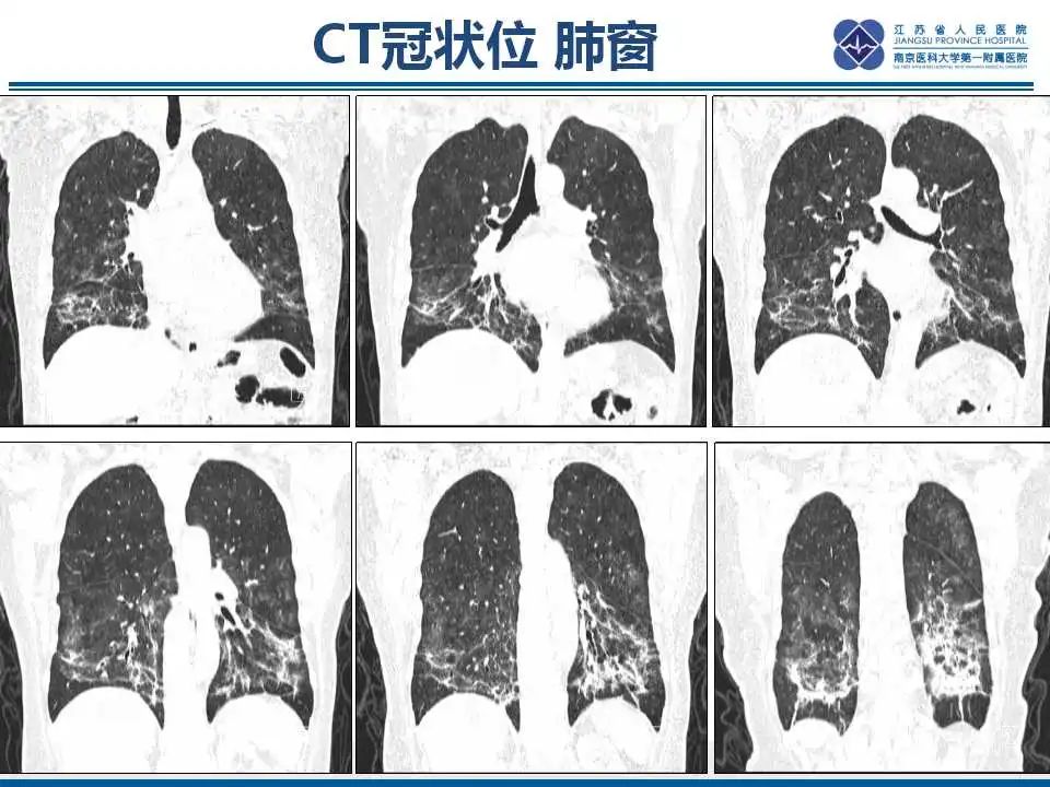 影像PPT - 【PPT】胺碘酮相关性肺损伤-5