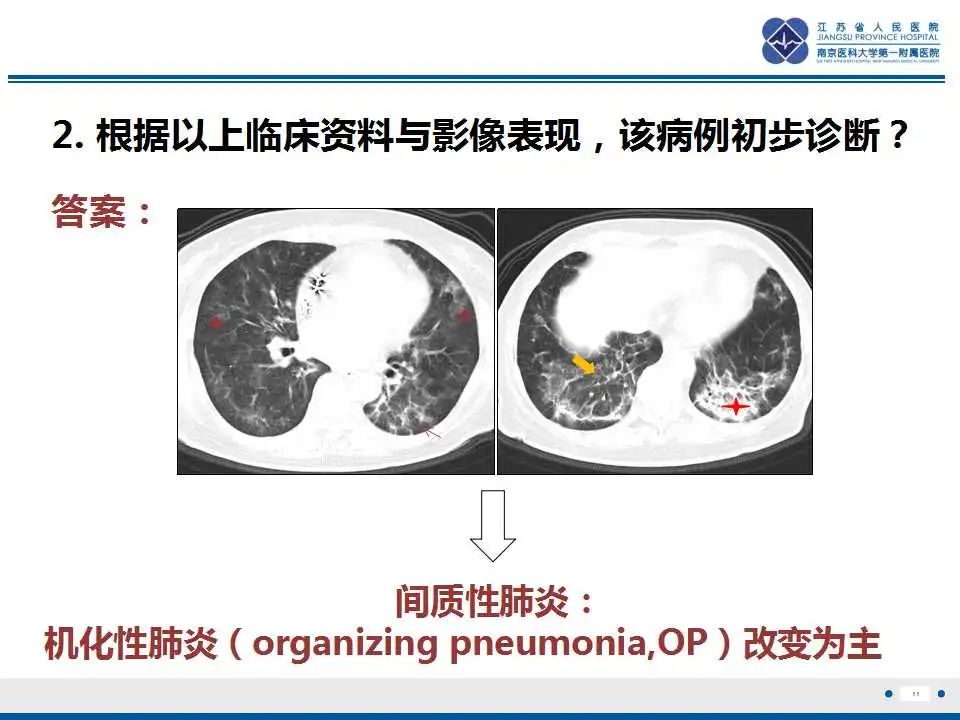 影像PPT - 【PPT】胺碘酮相关性肺损伤-12