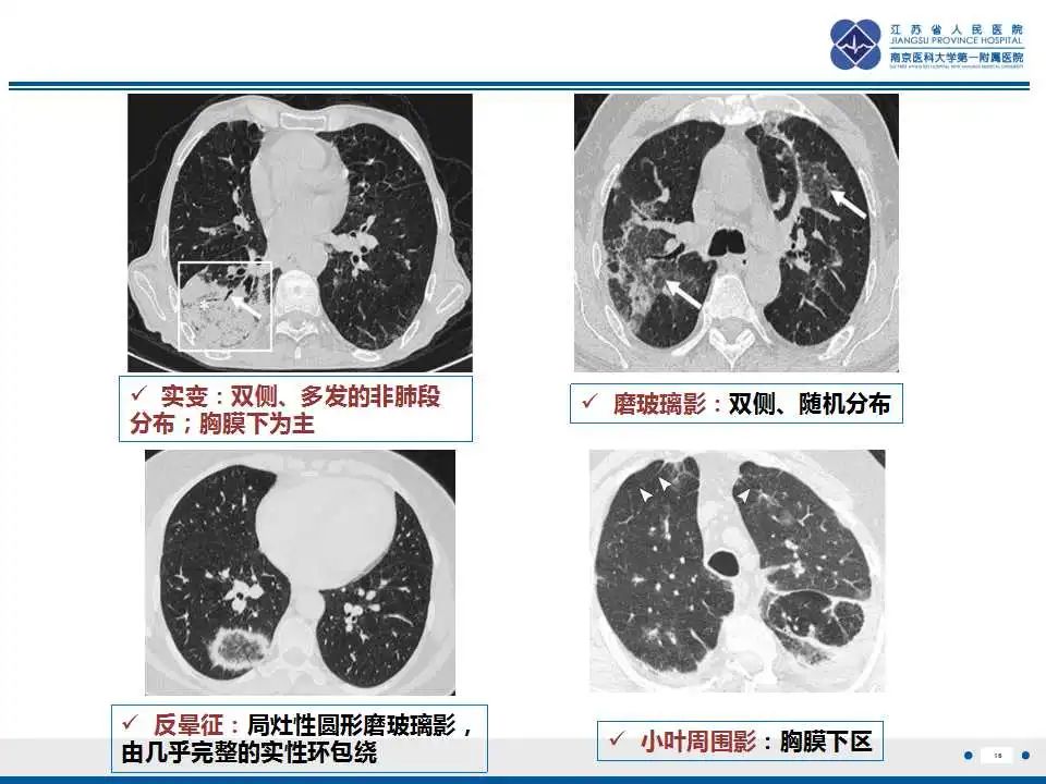 影像PPT - 【PPT】胺碘酮相关性肺损伤-17