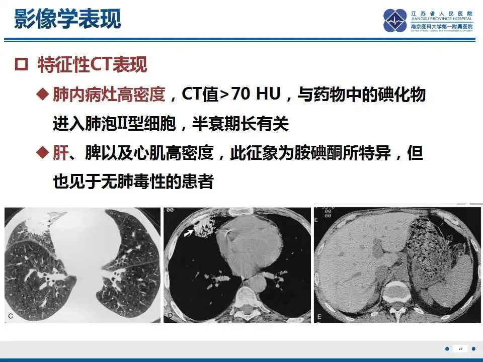 影像PPT - 【PPT】胺碘酮相关性肺损伤-28