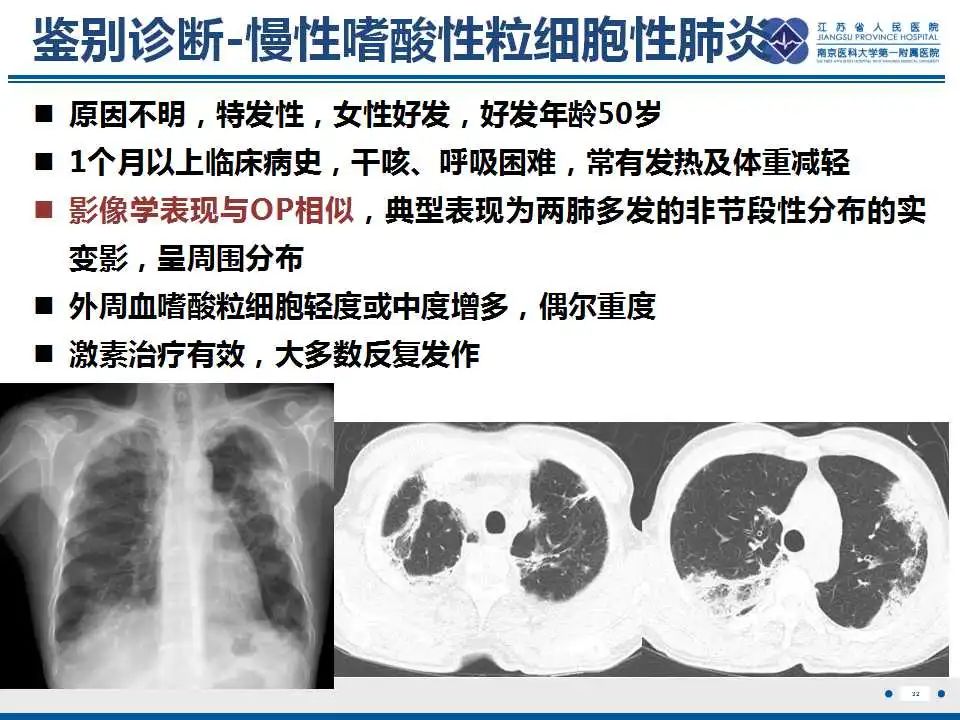 影像PPT - 【PPT】胺碘酮相关性肺损伤-33