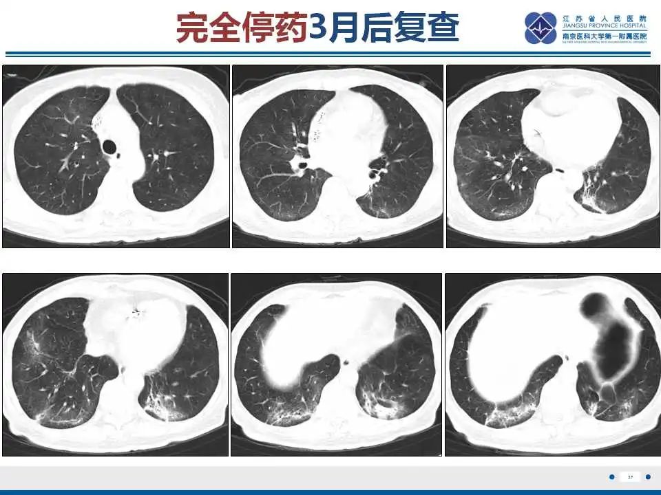 影像PPT - 【PPT】胺碘酮相关性肺损伤-37
