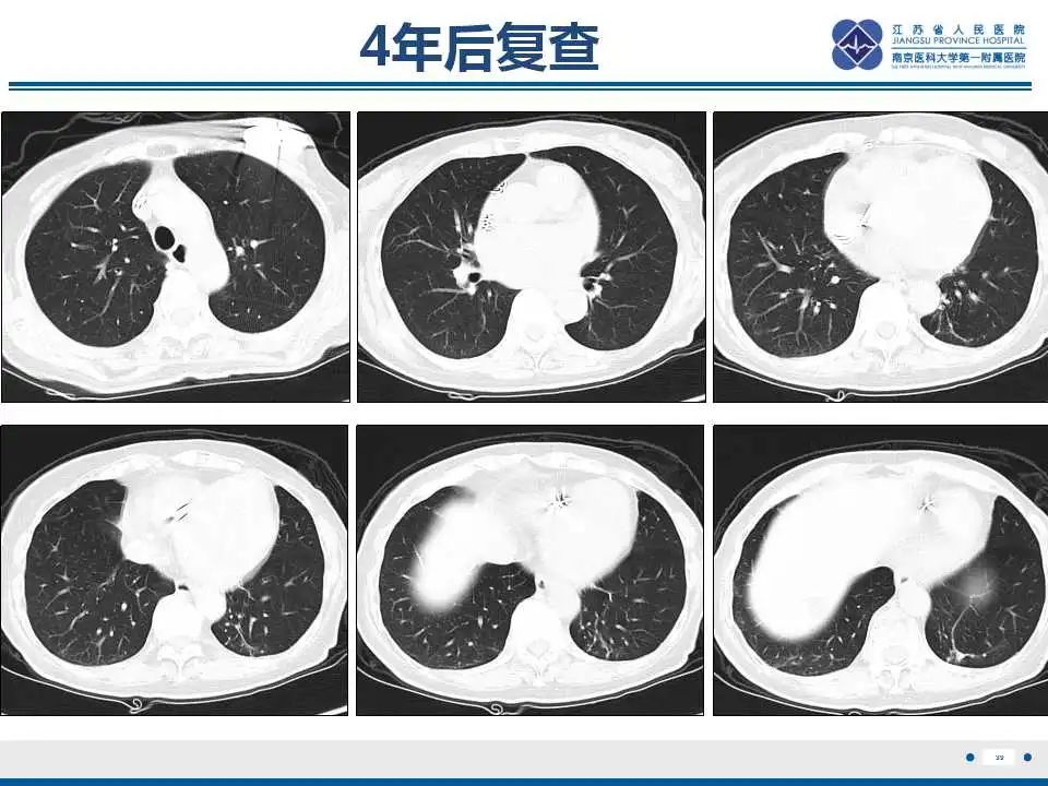 影像PPT - 【PPT】胺碘酮相关性肺损伤-39