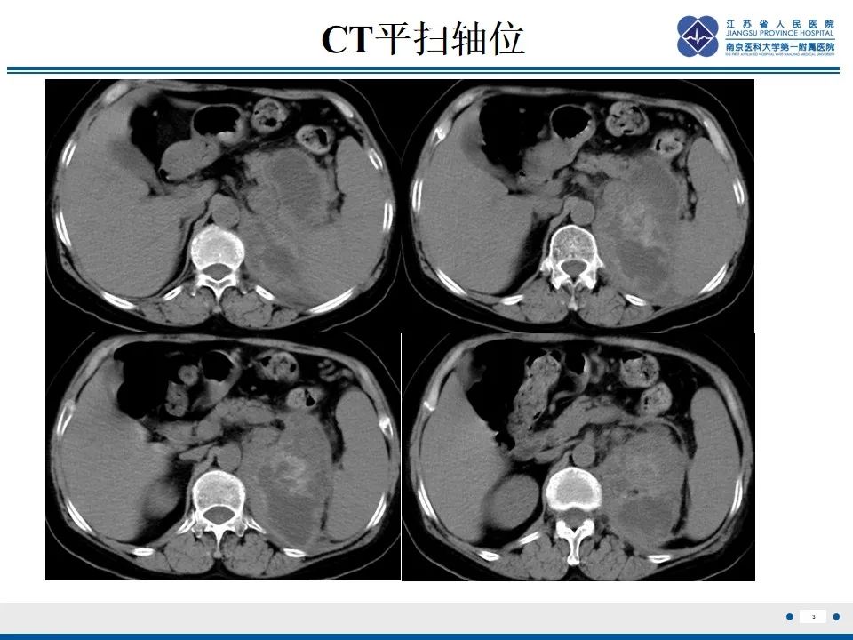 影像PPT - 【PPT】软斑病-4