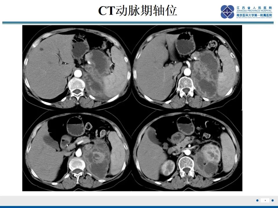 影像PPT - 【PPT】软斑病-5
