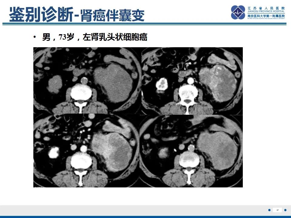影像PPT - 【PPT】软斑病-38