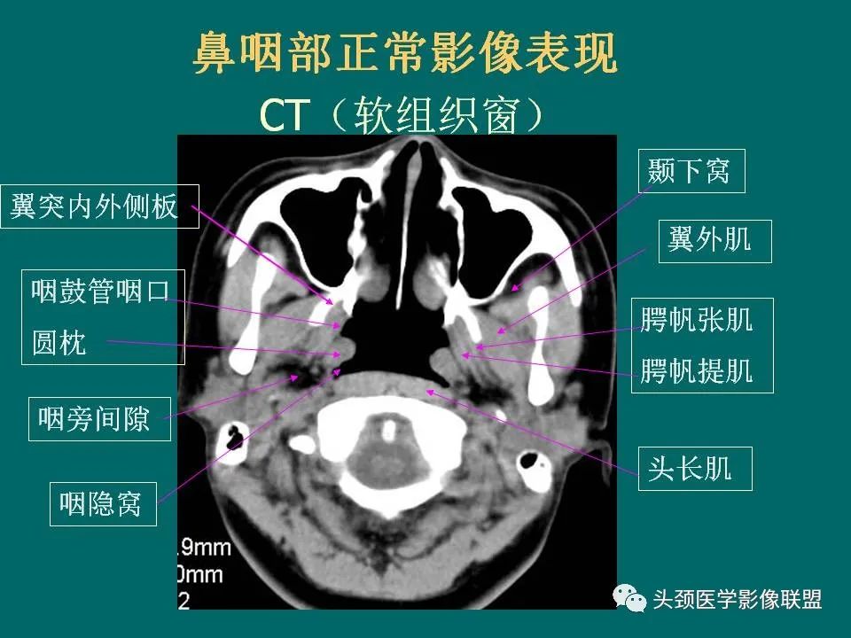 影像PPT - 【PPT】鼻咽癌的MRI诊断-5