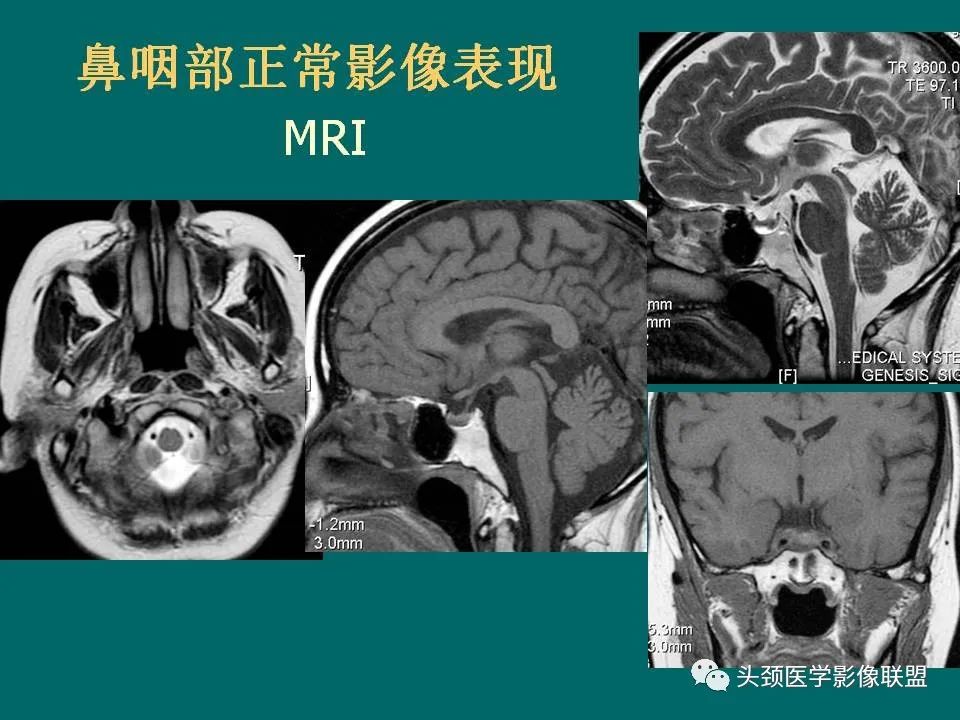 影像PPT - 【PPT】鼻咽癌的MRI诊断-7
