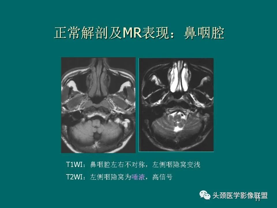 影像PPT - 【PPT】鼻咽癌的MRI诊断-11