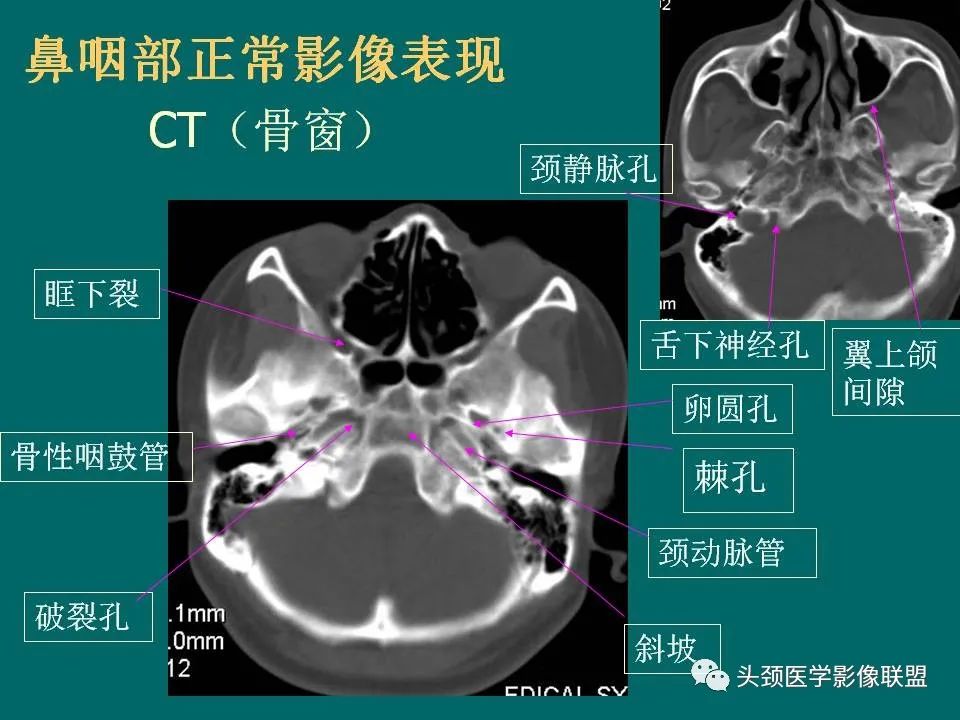 影像PPT - 【PPT】鼻咽癌的MRI诊断-6