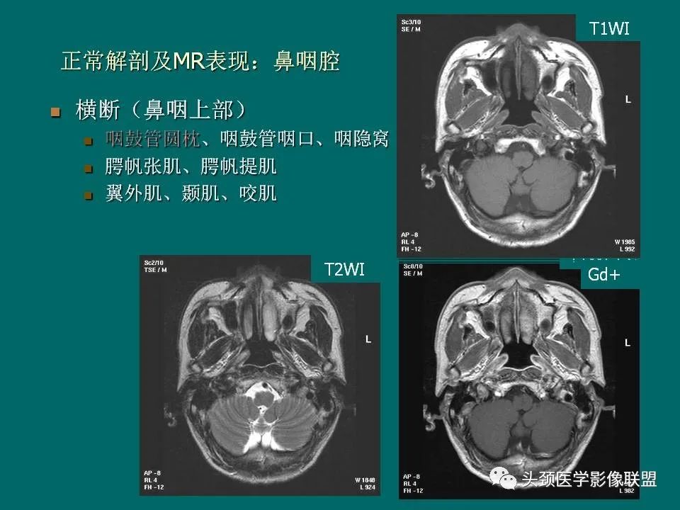 影像PPT - 【PPT】鼻咽癌的MRI诊断-13