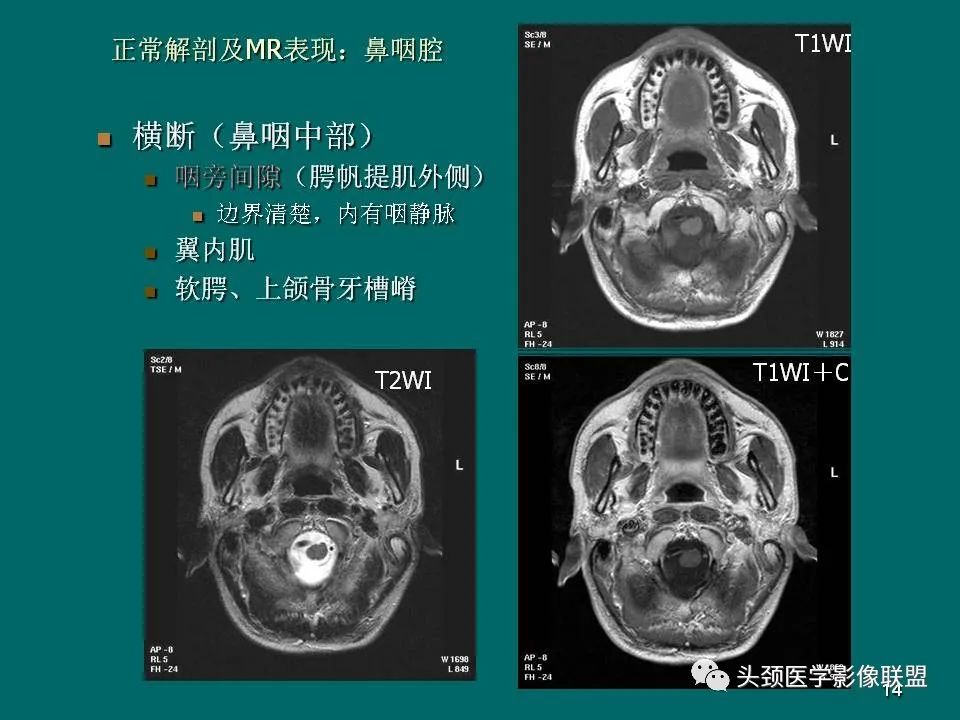 影像PPT - 【PPT】鼻咽癌的MRI诊断-14