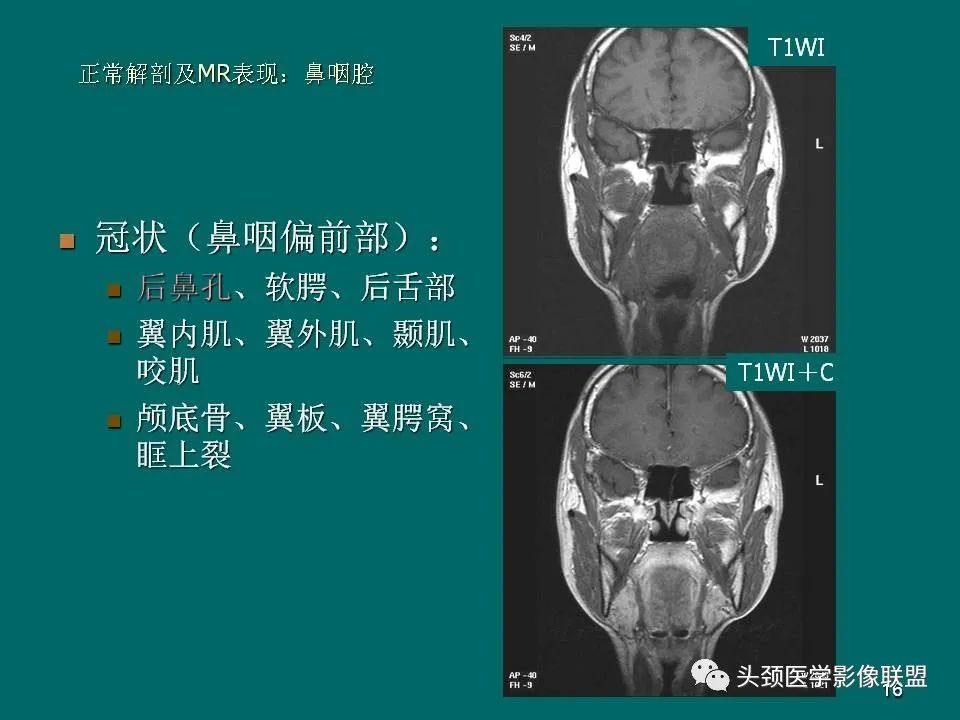 影像PPT - 【PPT】鼻咽癌的MRI诊断-16