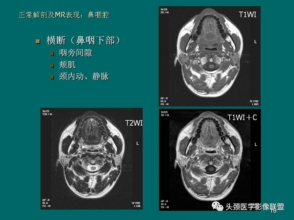 影像PPT - 【PPT】鼻咽癌的MRI诊断-15