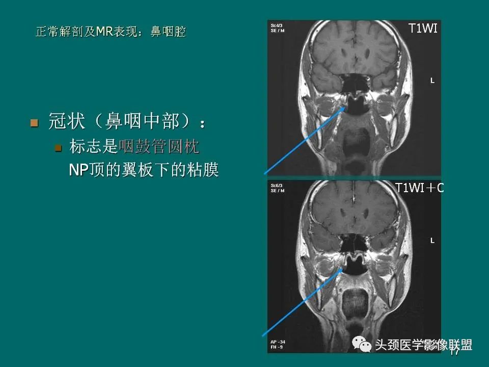 影像PPT - 【PPT】鼻咽癌的MRI诊断-17
